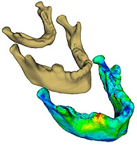 Growth prediction of a 12 year old mandibular bone based on a 3 months CT scan. The colour coding shows the prediction error. The red area is due to a missing tooth.
