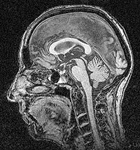 Mid-saggital MR brain image.