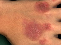 An example of psoriasis lesion image.