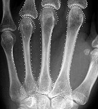 Metacarpal radiograph.