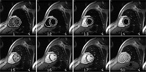 Selected frames of a registred perfusion sequence. Notice the contrast bolus that enters the right ventricle in frame 13.