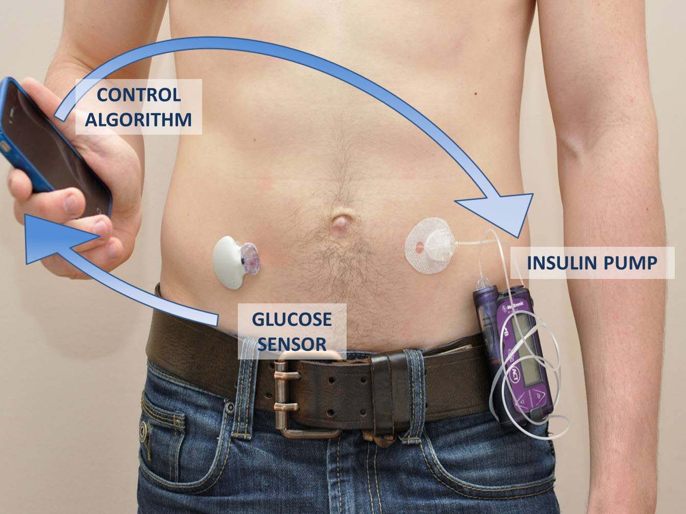 Portable Artifician Pancreas